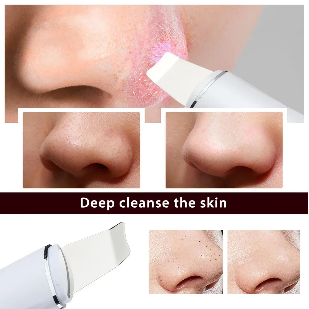Ultrasonic Skin Scrubber Peeling